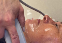 Lõtvunud naha pinguldamine kirurgilise sekkumiseta – HIFU smas lifting