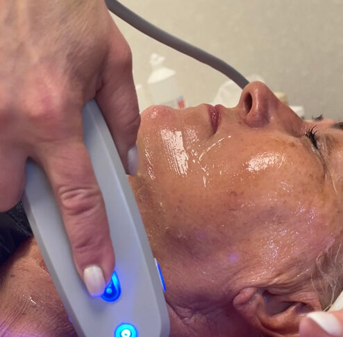 Lõtvunud naha pinguldamine kirurgilise sekkumiseta – HIFU smas lifting